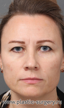 Комплексное эстетическое преображение лица: эндоскопический лифтинг лба и висков, верхняя и нижняя блефаропластика, риносептопластика, липофилинг лица